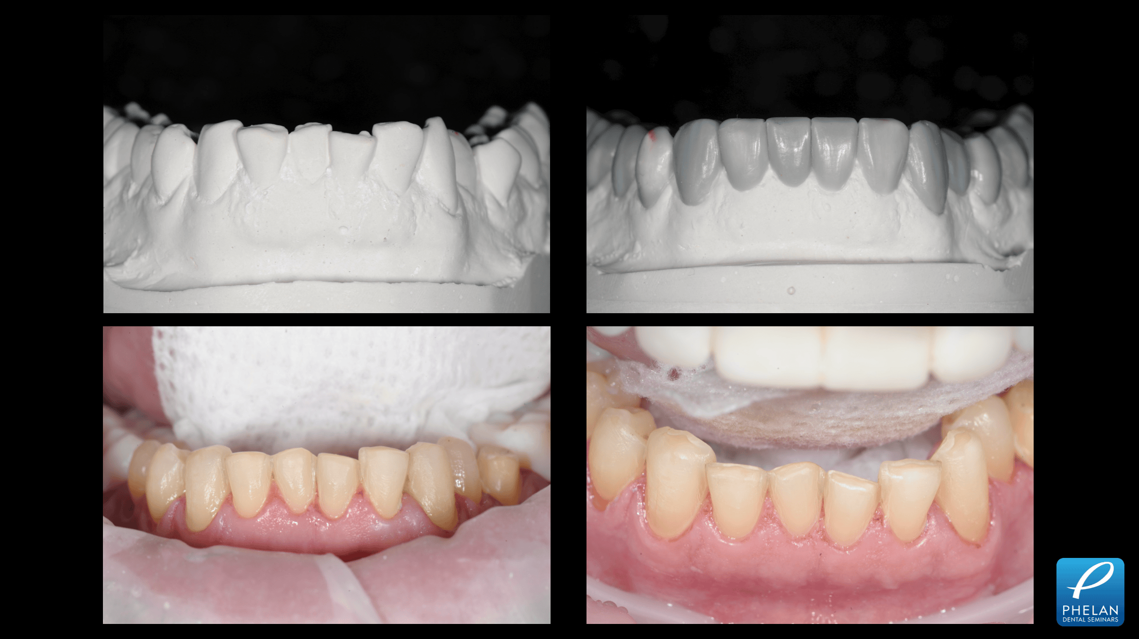 Image showcasing Porcelain Veneer Preparation Techniques Webinar