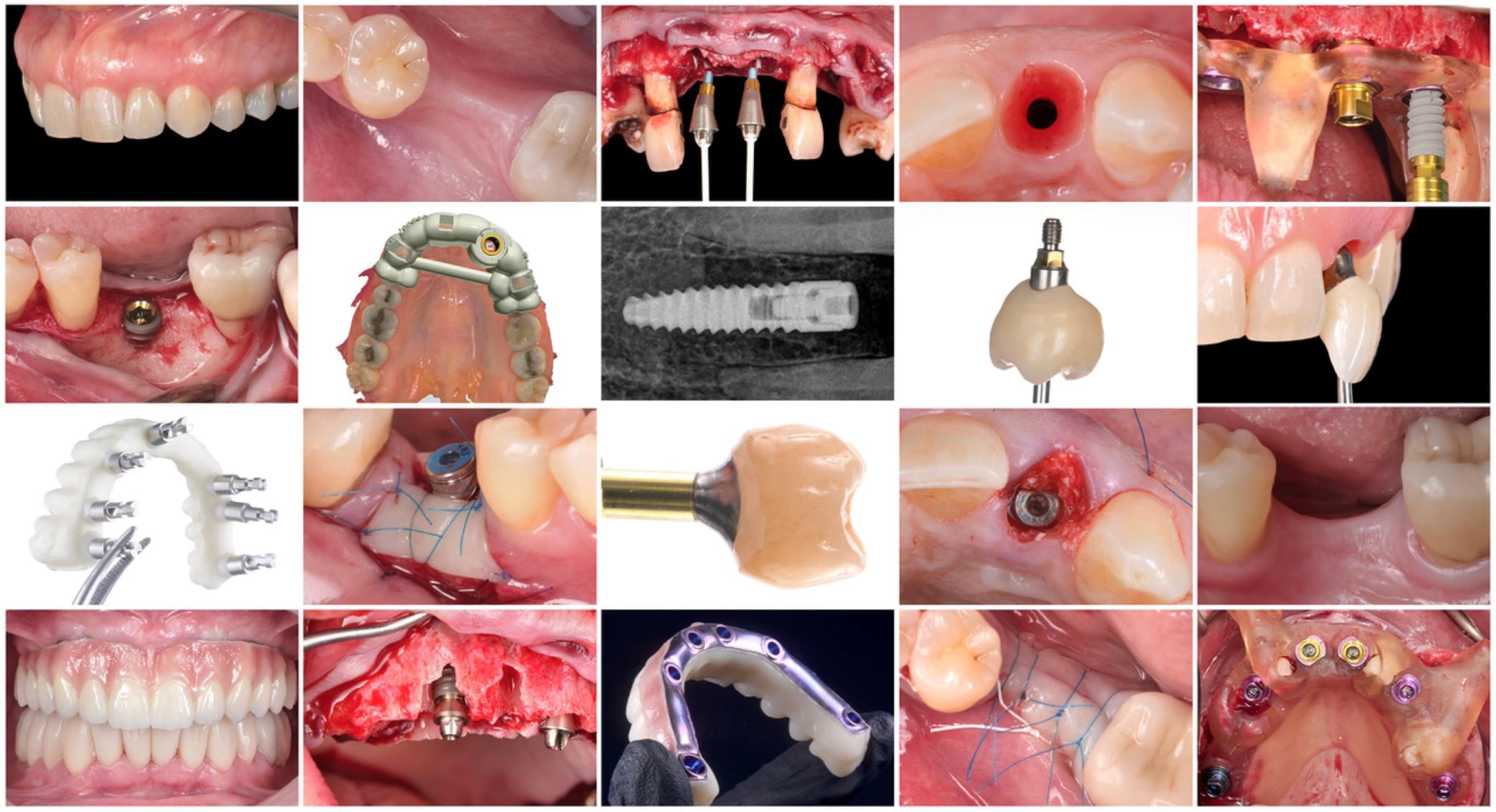 Implant Webinar